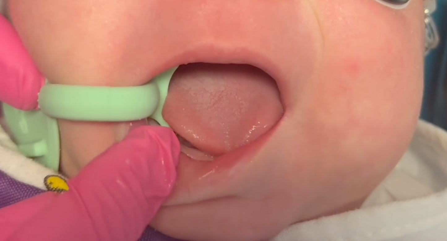 Chompr™ Mouth Prop