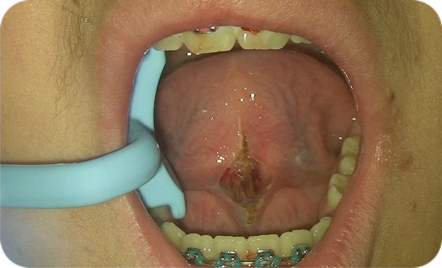 Chompr™ Mouth Prop